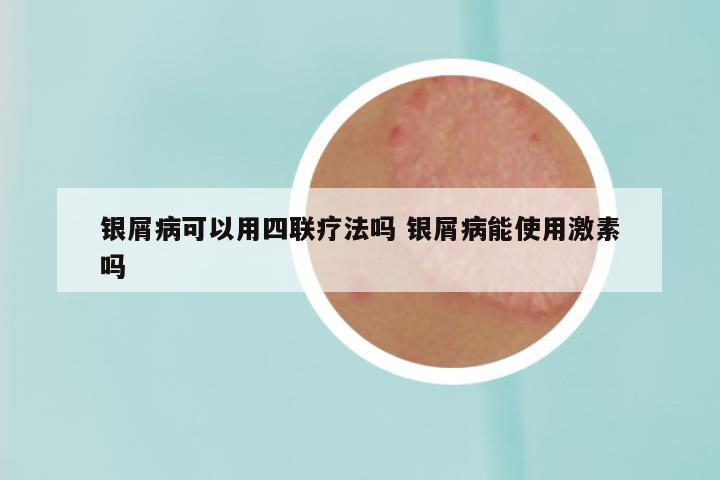 银屑病可以用四联疗法吗 银屑病能使用激素吗
