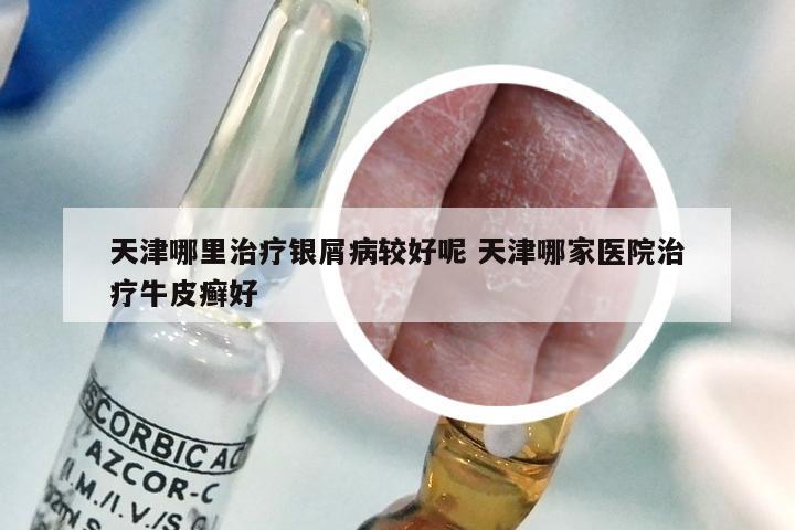 天津哪里治疗银屑病较好呢 天津哪家医院治疗牛皮癣好