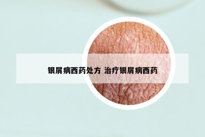 银屑病西药处方 治疗银屑病西药