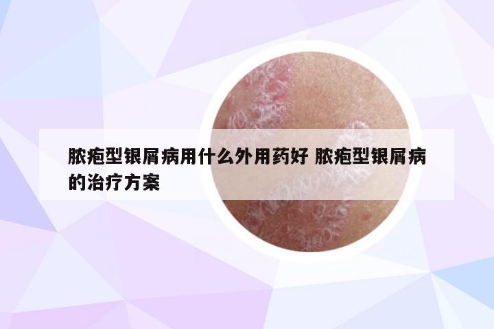 脓疱型银屑病用什么外用药好 脓疱型银屑病的治疗方案