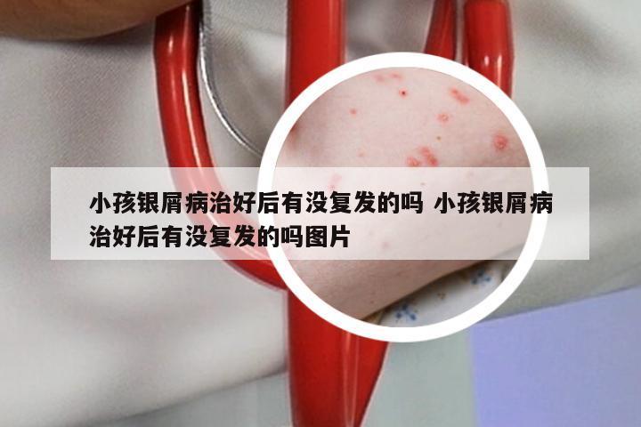 小孩银屑病治好后有没复发的吗 小孩银屑病治好后有没复发的吗图片