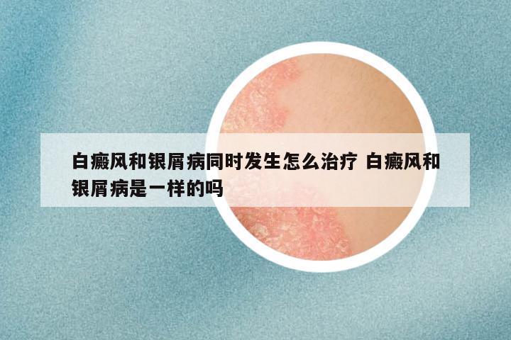 白癜风和银屑病同时发生怎么治疗 白癜风和银屑病是一样的吗