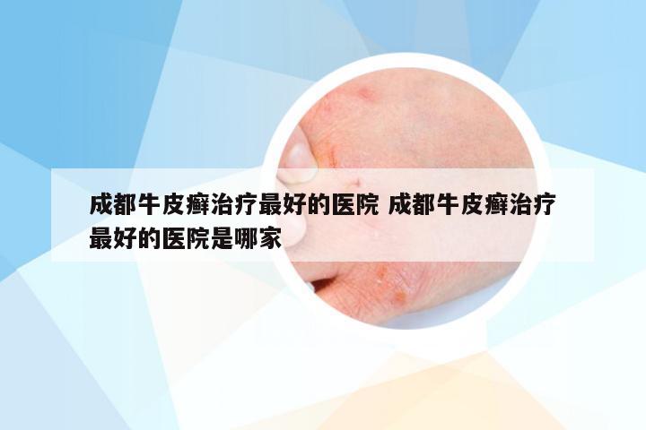 成都牛皮癣治疗最好的医院 成都牛皮癣治疗最好的医院是哪家