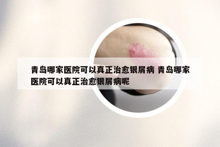 青岛哪家医院可以真正治愈银屑病 青岛哪家医院可以真正治愈银屑病呢