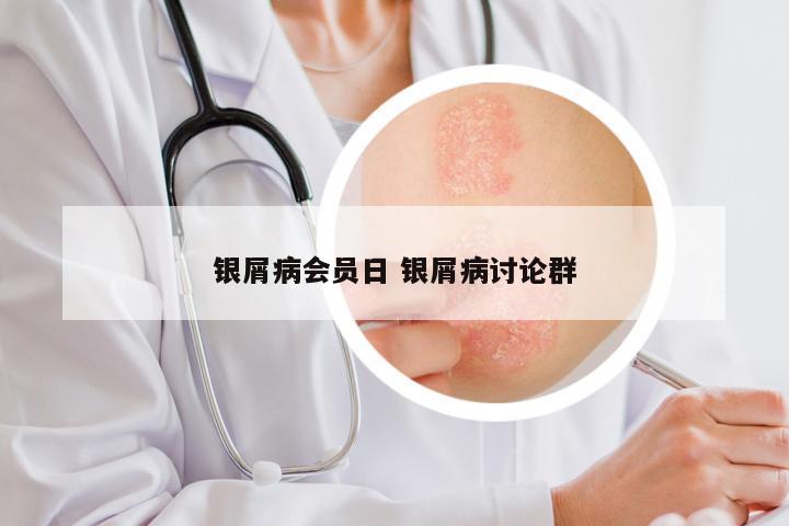 银屑病会员日 银屑病讨论群