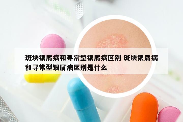 斑块银屑病和寻常型银屑病区别 斑块银屑病和寻常型银屑病区别是什么