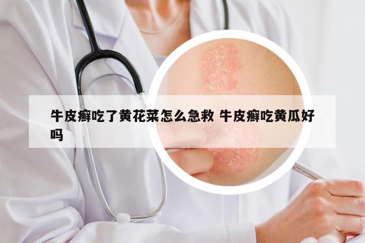 牛皮癣吃了黄花菜怎么急救 牛皮癣吃黄瓜好吗
