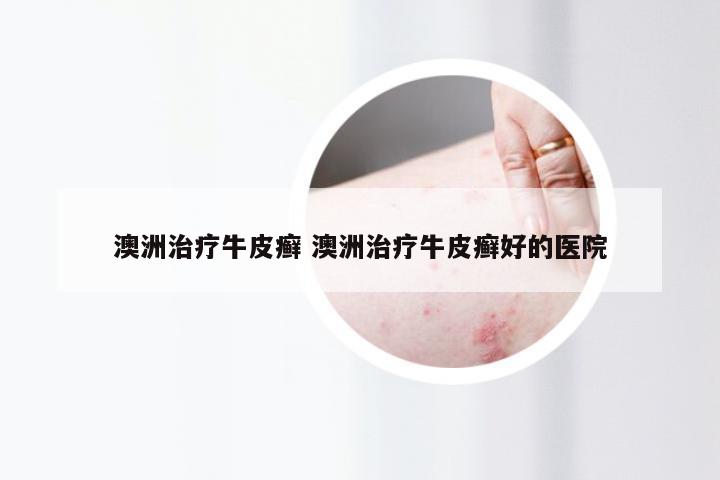 澳洲治疗牛皮癣 澳洲治疗牛皮癣好的医院