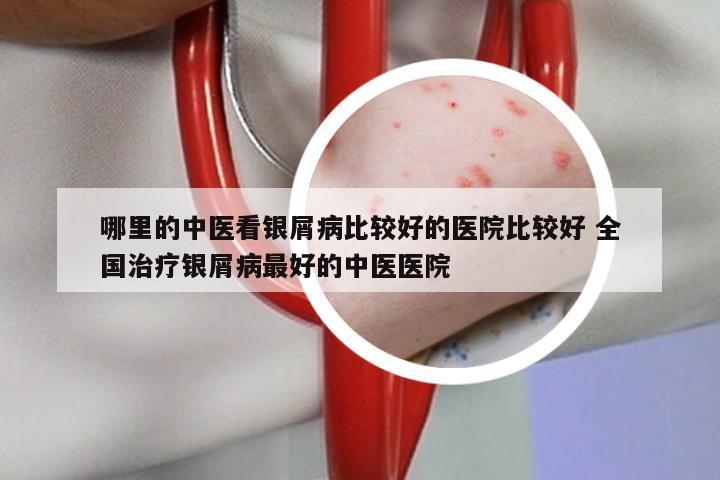 哪里的中医看银屑病比较好的医院比较好 全国治疗银屑病最好的中医医院