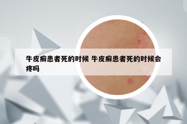 牛皮癣患者死的时候 牛皮癣患者死的时候会疼吗