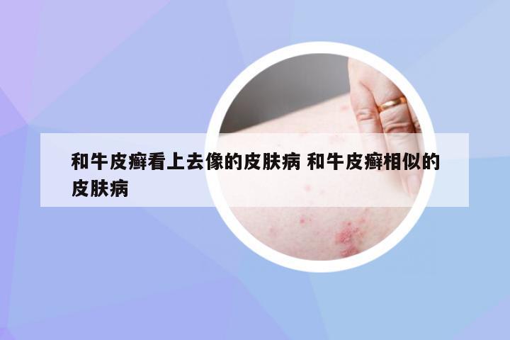和牛皮癣看上去像的皮肤病 和牛皮癣相似的皮肤病