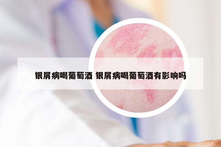 银屑病喝葡萄酒 银屑病喝葡萄酒有影响吗