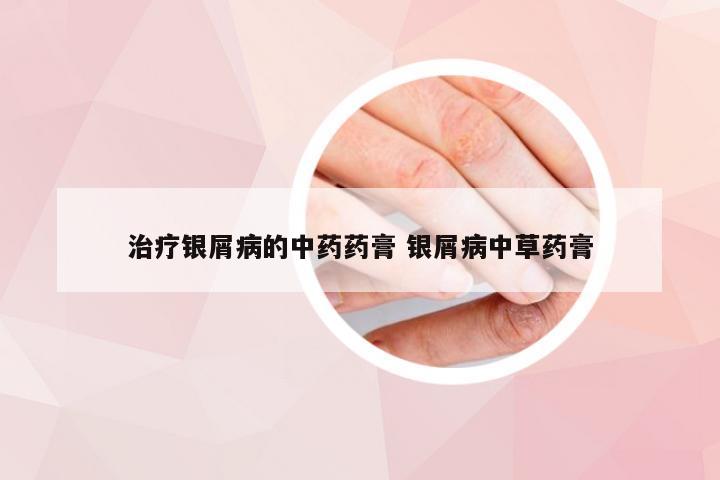 治疗银屑病的中药药膏 银屑病中草药膏