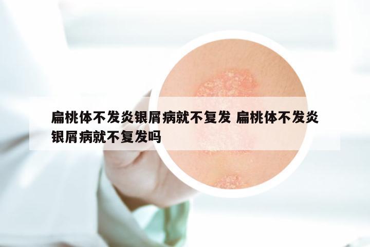 扁桃体不发炎银屑病就不复发 扁桃体不发炎银屑病就不复发吗