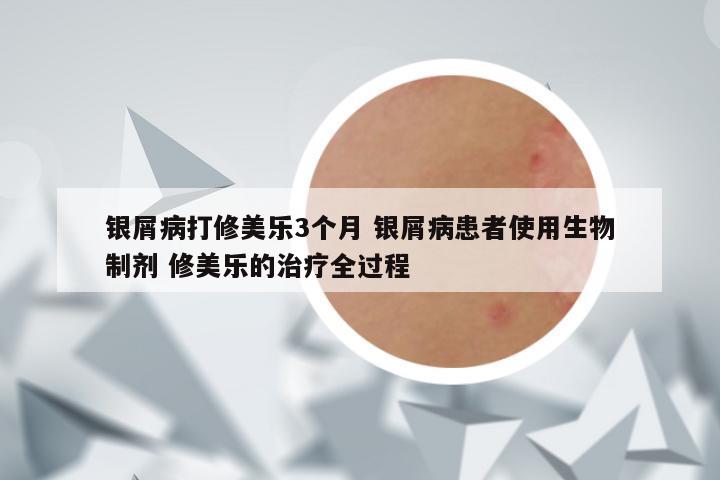 银屑病打修美乐3个月 银屑病患者使用生物制剂 修美乐的治疗全过程