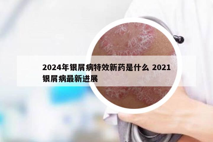 2024年银屑病特效新药是什么 2021银屑病最新进展