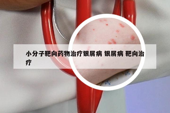 小分子靶向药物治疗银屑病 银屑病 靶向治疗