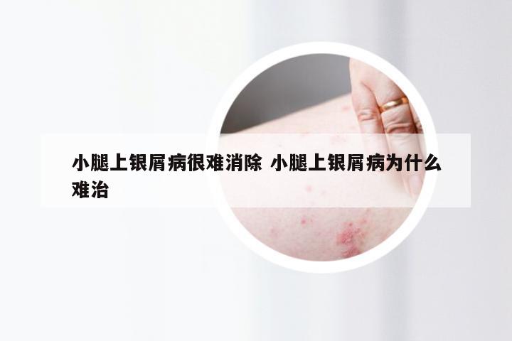 小腿上银屑病很难消除 小腿上银屑病为什么难治