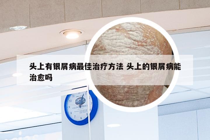 头上有银屑病最佳治疗方法 头上的银屑病能治愈吗