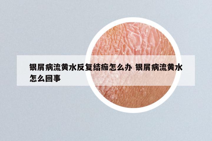 银屑病流黄水反复结痂怎么办 银屑病流黄水怎么回事