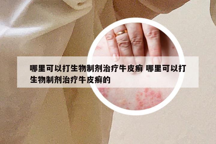 哪里可以打生物制剂治疗牛皮癣 哪里可以打生物制剂治疗牛皮癣的