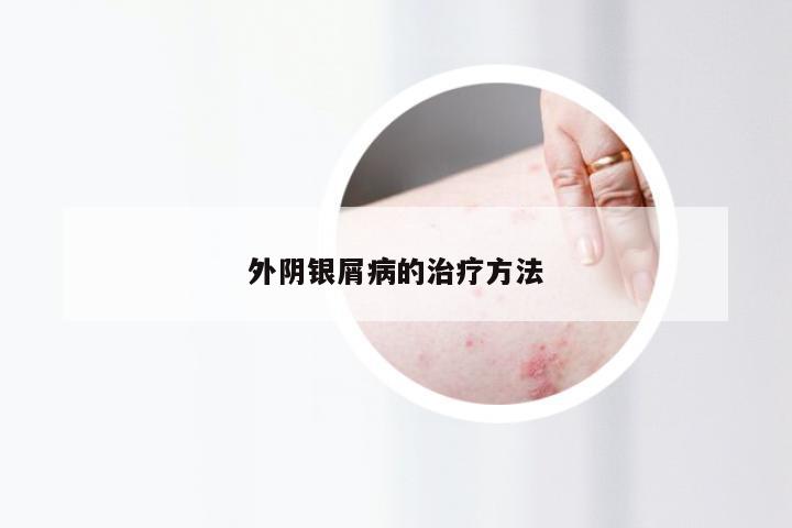 外阴银屑病的治疗方法