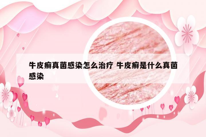 牛皮癣真菌感染怎么治疗 牛皮癣是什么真菌感染