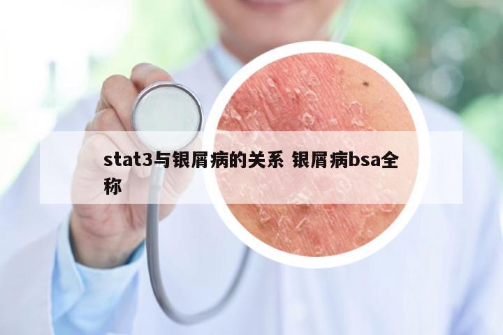stat3与银屑病的关系 银屑病bsa全称