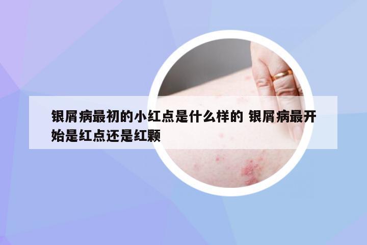 银屑病最初的小红点是什么样的 银屑病最开始是红点还是红颗