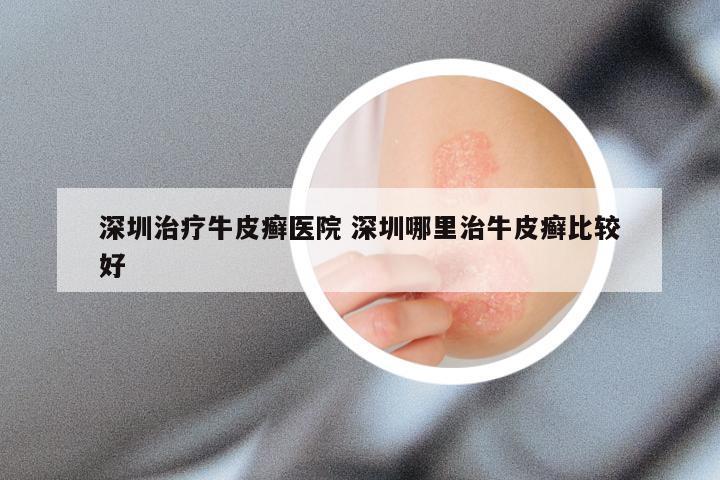 深圳治疗牛皮癣医院 深圳哪里治牛皮癣比较好