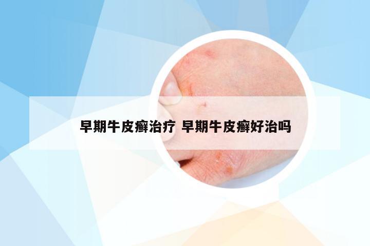 早期牛皮癣治疗 早期牛皮癣好治吗