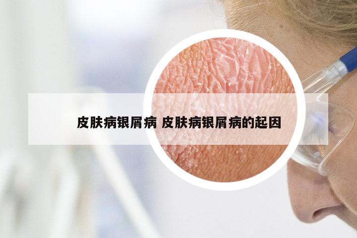 皮肤病银屑病 皮肤病银屑病的起因