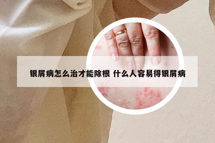 银屑病怎么治才能除根 什么人容易得银屑病