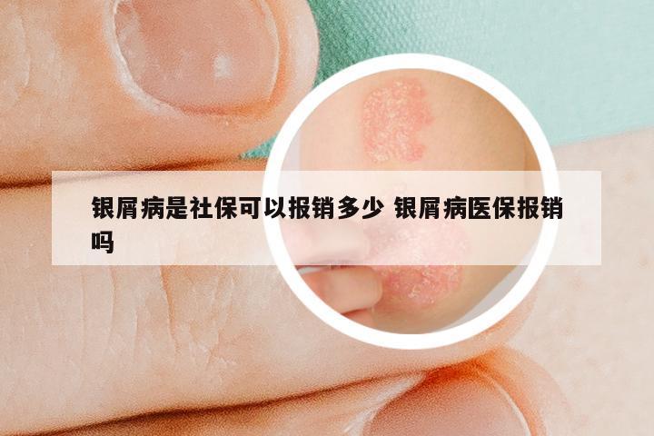 银屑病是社保可以报销多少 银屑病医保报销吗