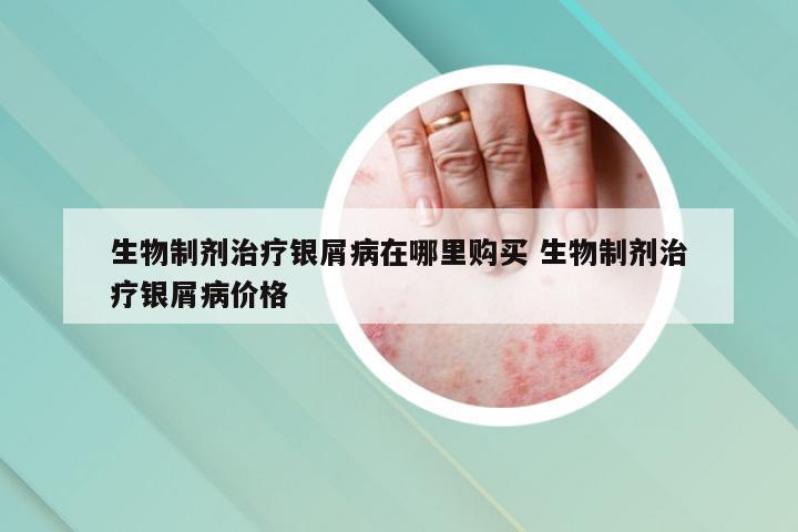 生物制剂治疗银屑病在哪里购买 生物制剂治疗银屑病价格