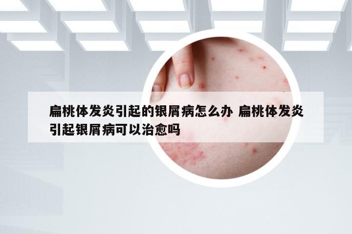 扁桃体发炎引起的银屑病怎么办 扁桃体发炎引起银屑病可以治愈吗