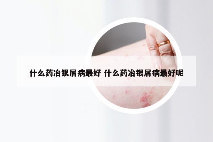 什么药冶银屑病最好 什么药冶银屑病最好呢