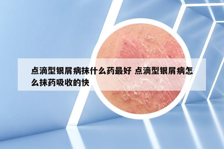 点滴型银屑病抹什么药最好 点滴型银屑病怎么抹药吸收的快