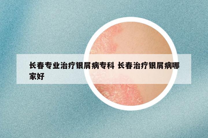 长春专业治疗银屑病专科 长春治疗银屑病哪家好