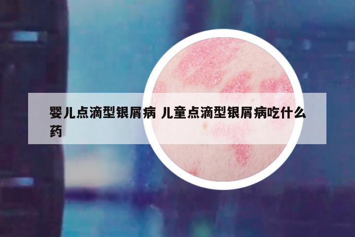 婴儿点滴型银屑病 儿童点滴型银屑病吃什么药