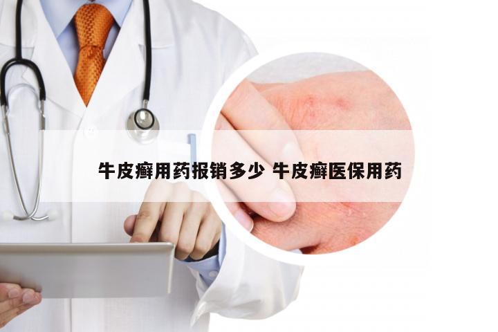 牛皮癣用药报销多少 牛皮癣医保用药