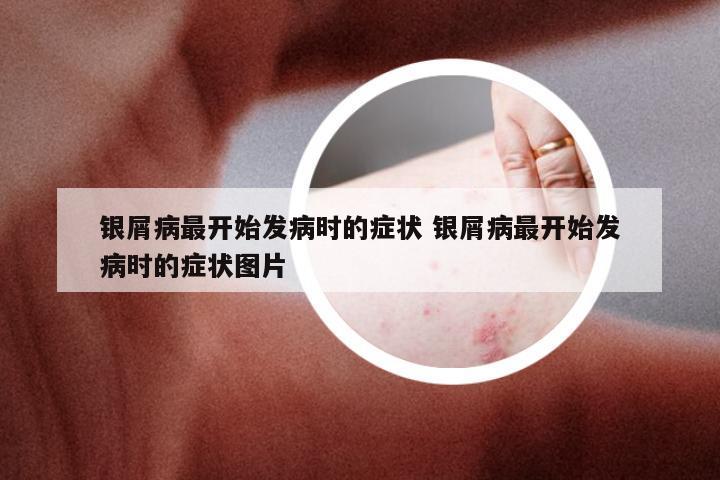 银屑病最开始发病时的症状 银屑病最开始发病时的症状图片