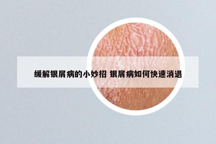 缓解银屑病的小妙招 银屑病如何快速消退