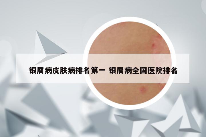 银屑病皮肤病排名第一 银屑病全国医院排名