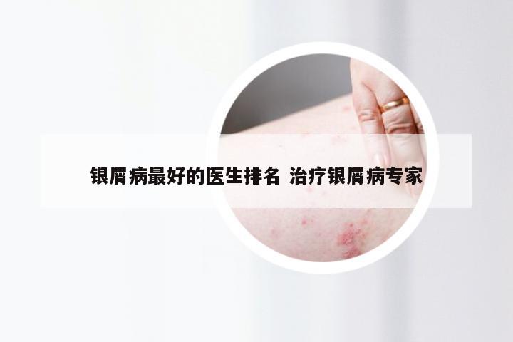 银屑病最好的医生排名 治疗银屑病专家