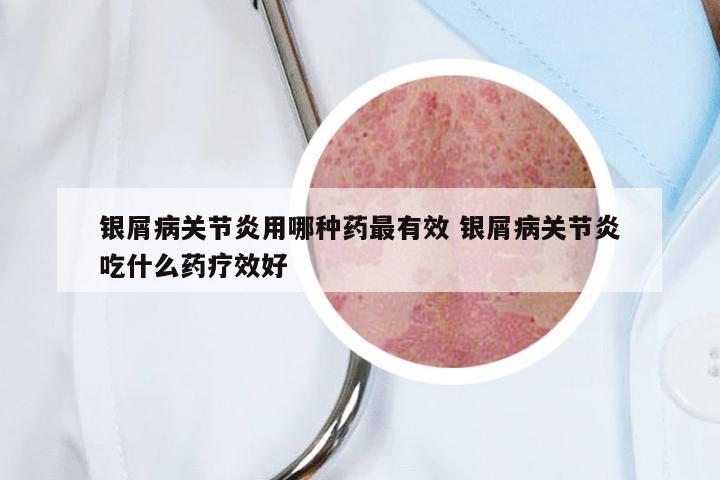 银屑病关节炎用哪种药最有效 银屑病关节炎吃什么药疗效好