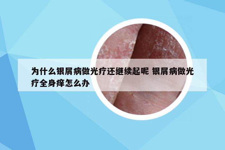 为什么银屑病做光疗还继续起呢 银屑病做光疗全身痒怎么办