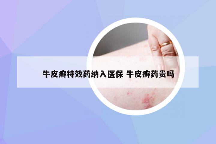 牛皮癣特效药纳入医保 牛皮癣药贵吗