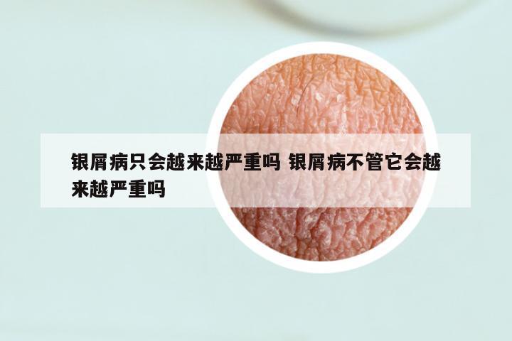 银屑病只会越来越严重吗 银屑病不管它会越来越严重吗
