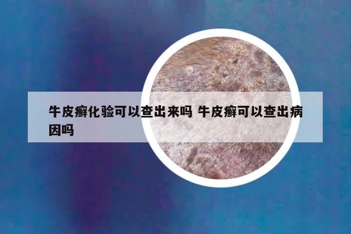 牛皮癣化验可以查出来吗 牛皮癣可以查出病因吗